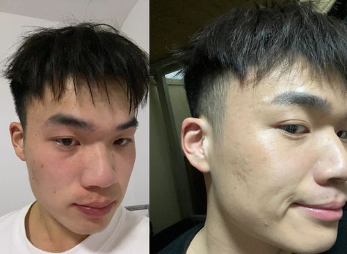 男生下头长痘痘，是传染病吗？揭秘痘痘成因与防治策略