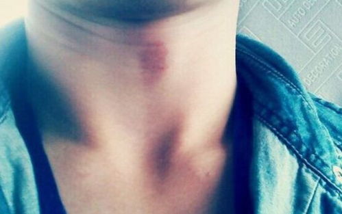 《草莓印记下的爱情密码：揭秘另一半脖子上的“神秘符号”》