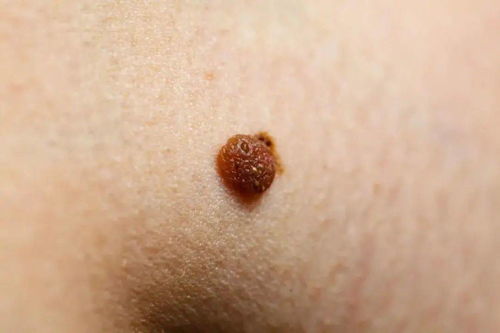 揭秘女性大腿两侧瘙痒与小肉芽的秘密——专家解读及应对策略