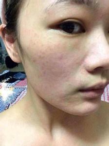 婚后斑点困扰？揭秘女性婚后肌肤变化背后的秘密