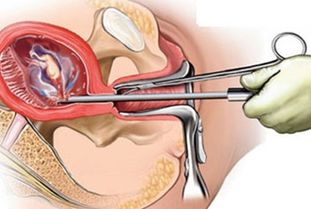 小三介入婚姻，打胎后感情能否修复？揭秘婚姻裂痕下的情感重建