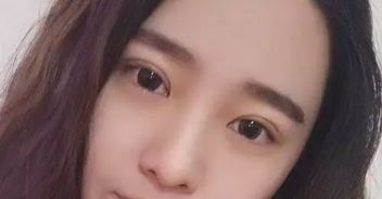 《割双眼皮后反悔？揭秘男生双眼皮手术的常见问题与应对策略》
